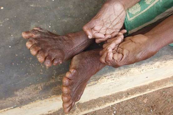 انگشتان زیاد دست و پای زن هندی!  (+تصاویر)
