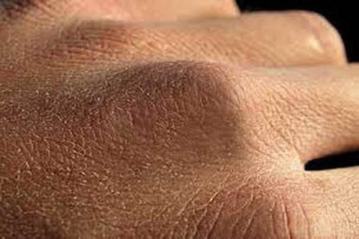 از مهم‌ترین توصیه‌های متخصصان برای مقابله با کووید ۱۹ شستن مرتب دست‌هاست اما شستن مکرر دست‌ها می‌تواند مشکلات پوستی مختلفی از جمله اگزما و خشکی شدید به همراه داشته باشد.