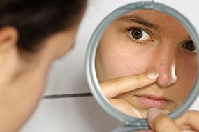 روش هایی برای درمان جای جوش روی صورت