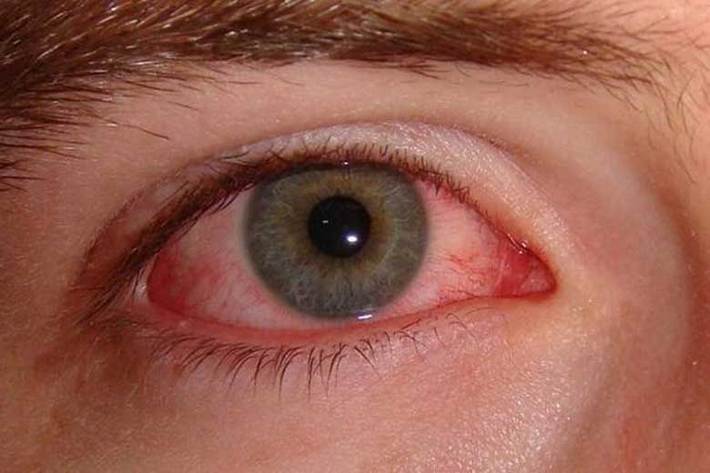 محققان چینی اعلام کرد؛ ویروس کرونا می تواند منجر به بروز عارضه «چشم صورتی» شود و این ویروس از طریق اشک چشم قابل انتقال است.