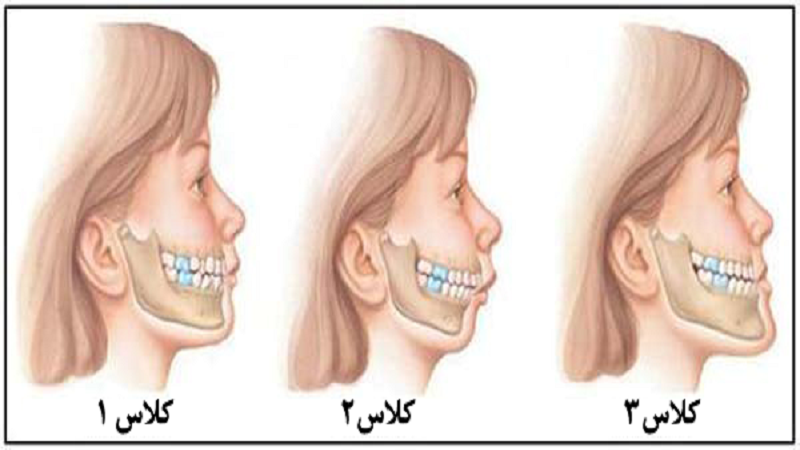 6 پارگی و ظن کامل نادرست دربارا آرتودنسه دندان تصور کن.