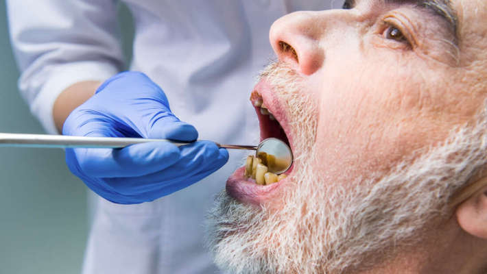 مسواک نزدن دندان‌هایتان می‌تواند مشکلات گسترده‌ای را برای سلامت دندان‌ها و نیاز به مراجعه به دندان‌پزشک برایتان ایجاد کند. اما از زمان آغاز همه‌گیری کووید-۱۹، این موضوع می‌تواند منجر به مشکلات بزرگ‌تری نیز شود. شواهد فزاینده‌ای وجود دارد که نشان می‌دهد سلامت ضعیف دهان و دندان خطر ابتلا به کووید-۱۹ را افزایش می‌دهد.