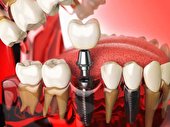 ایمپلنت دندان: انواع، مراحل و عوارض آن